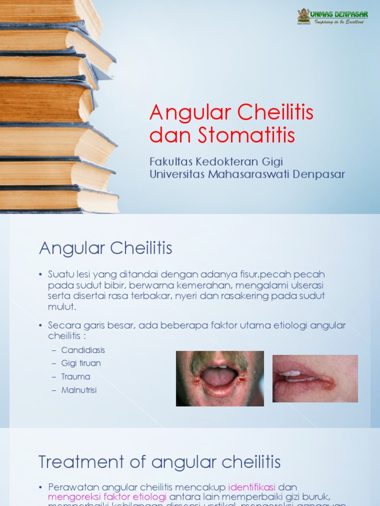 Angular Cheilitis Dan Stomatitis | PDF