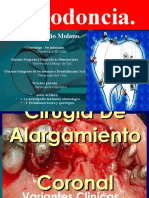 Cirugiadealargamientocoronalpreprotesica 140325222228 Phpapp01 PDF