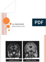 alzheimer