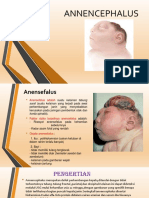 Malformasi anensefalus 