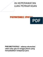 Pneumothorax 