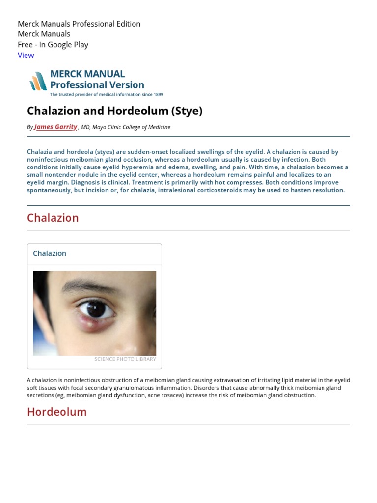 Chalazion and Hordeolum (Stye) Eye Disorders Merck Manuals