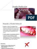 Raspado y Alisado Radicular