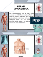 Hernia Epigastrica