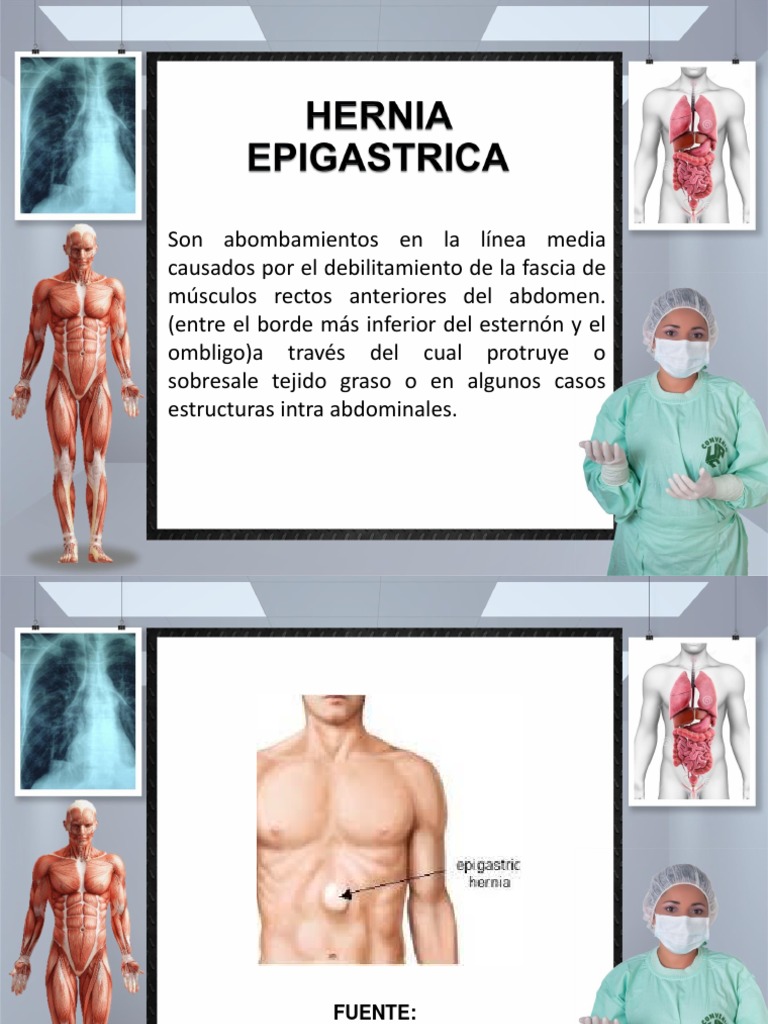 Hernia Epigastrica PDF Abdomen Anatomía