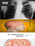 Avc –Acidente Vascular Encefálico