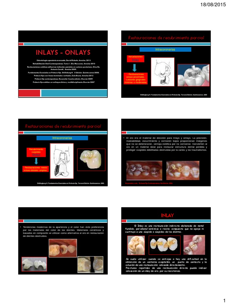 Preparación de Inlays y Onlays Dentales | PDF | Dentadura postiza ...