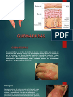 Quemaduras