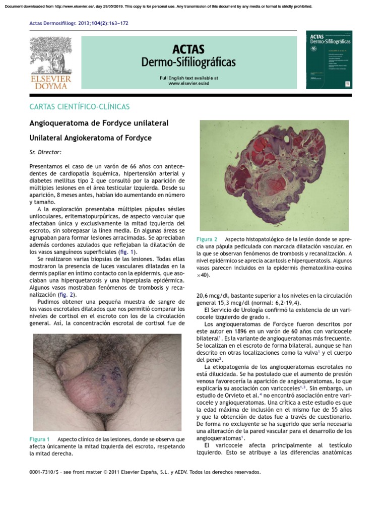 Angioqueratoma de Fordyce Descargar gratis PDF Angiología