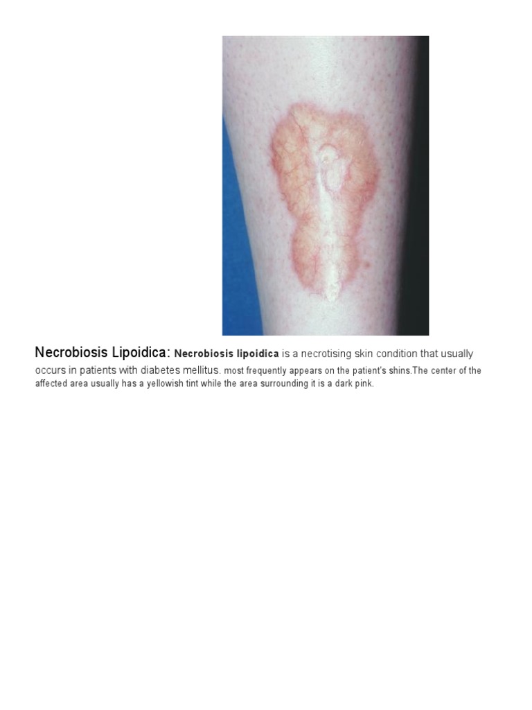 A Comprehensive Review of Several Cutaneous Conditions Associated with ...