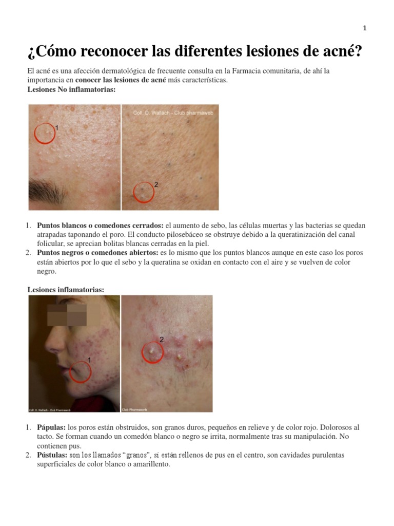 c-mo-reconocer-las-diferentes-lesiones-de-acn-pdf