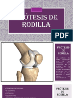 Prótesis de Rodilla