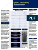 ECG Discussion: Wellens Syndrome: A Subtle ECG Finding