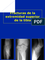 Fracturas Proximales de La Tibia