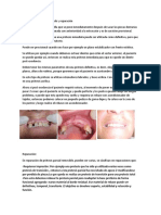 Protesis Inmediata,Rebasado y Reparacion