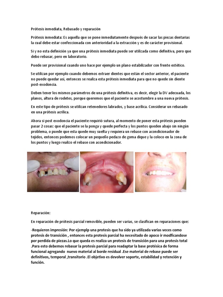 Protesis Inmediata, Rebasado y Reparacion | PDF | Dentadura postiza ...