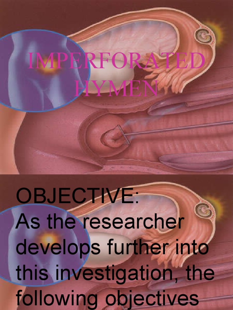 Understanding Imperforate Hymen | PDF | Vagina | Uterus