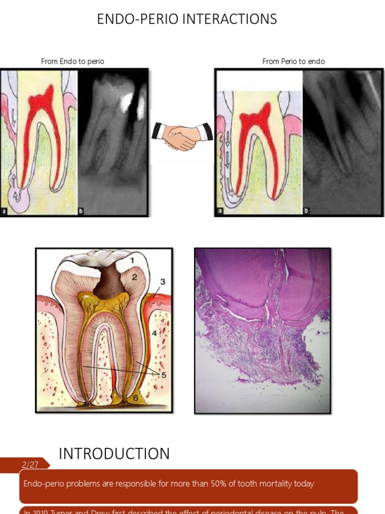 Endo Perio Lesions PDF Mouth Dentistry