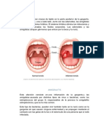 Informe Amigdalitis2