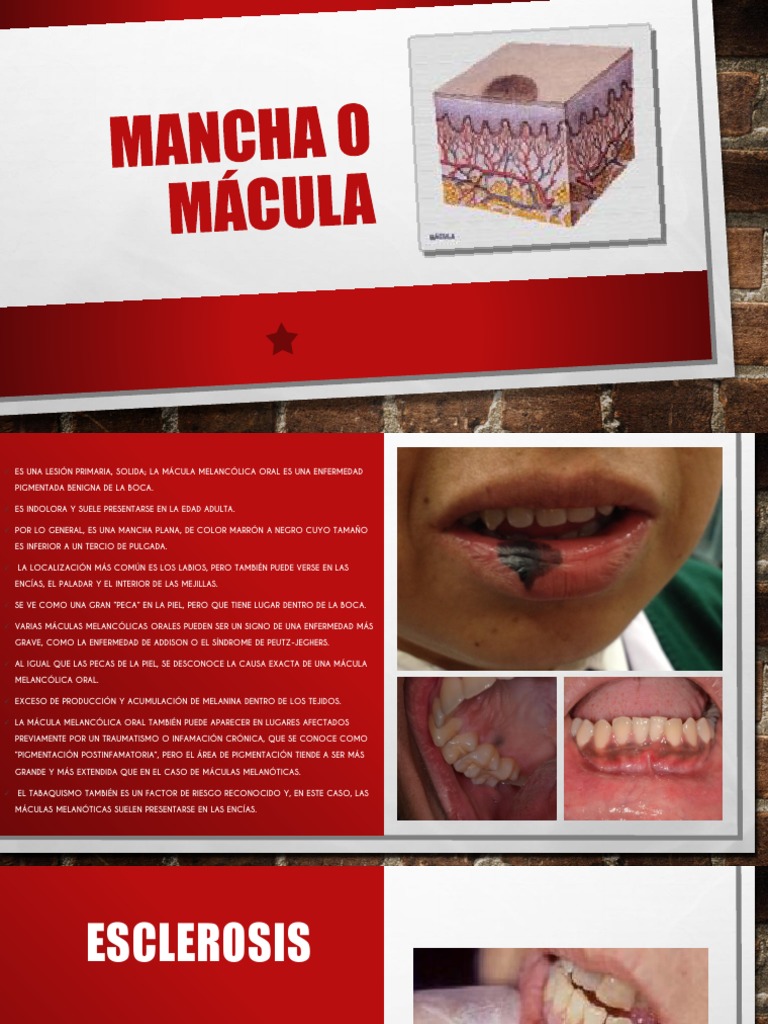 mcula melantica oral causas Oral: y Tratamiento | PDF | Medicina CLINICA Mcula Melantica Oral: Causas y