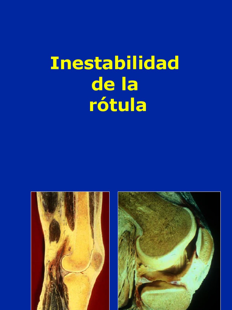 Inestabilidad de la Rótula: Diagnóstico y Tratamiento | PDF | Rodilla ...