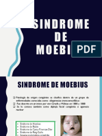 Sindrome de Moebius