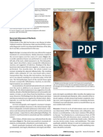 Recurrent Abscesses of The Neck: Scrofuloderma: Bacterium Tuberculosis PCR Were Negative. A Culture Was Not