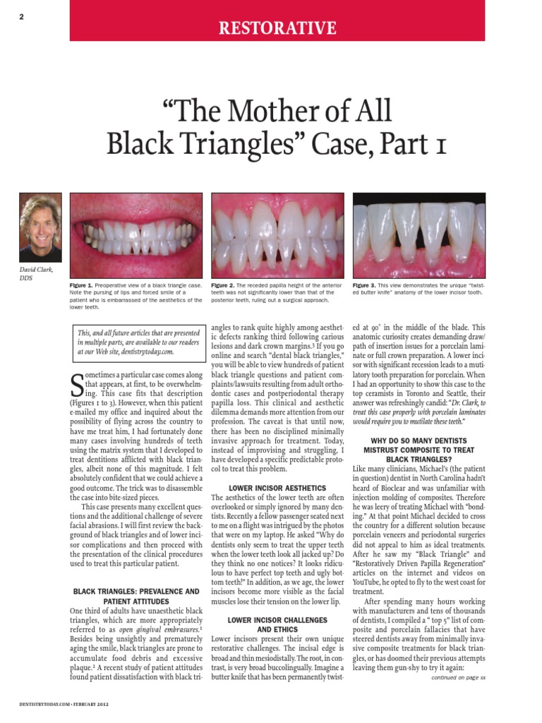 Treating Black Triangles in Dentistry | PDF | Tooth Enamel | Orthodontics