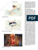 Part VIII: Nongastrointestinal Transabdominal Surgery: Intraperitoneal Mesh Repair