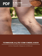 Termoablação com Endolaser - Dr. Alexandre Amato
