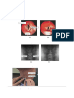 Arytenoid Dislocation: A New Diagnostic and Treatment Approach