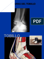 Fractura de Tobillo