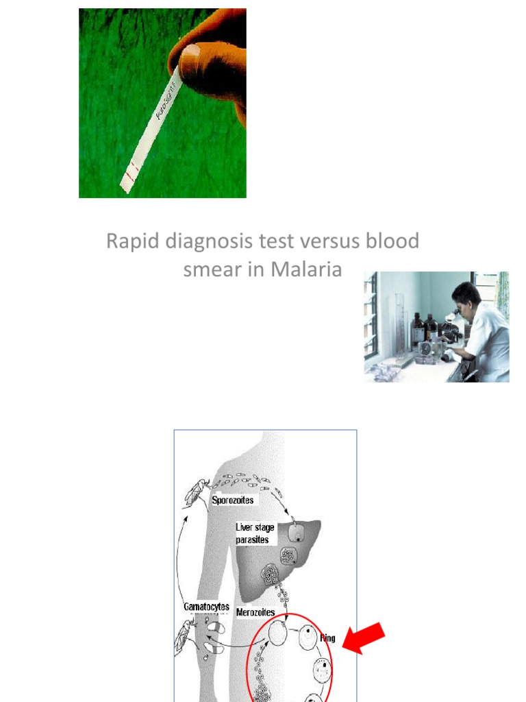 Rapid Diagnosis Test Versus Blood Smear in Malaria | PDF | Malaria ...