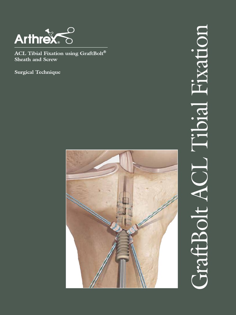 ACL Tibial Fixation Using GraftBolt Surgical Technique | PDF | Screw | Knee