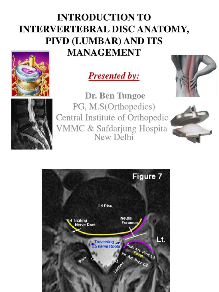 Understanding PIVD: Types and Management | PDF | Vertebral Column ...