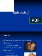 Epistaxis