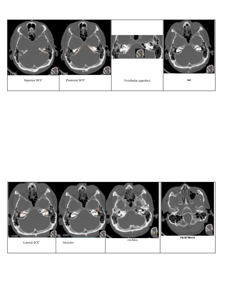 Superior SCC Posterior SCC Vestibular Aqueduct | PDF | Hearing ...