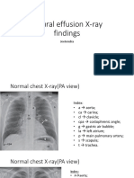 Pleural Effusion X-Ray Findings: Jeetendra
