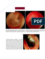 Acute Otitis Media