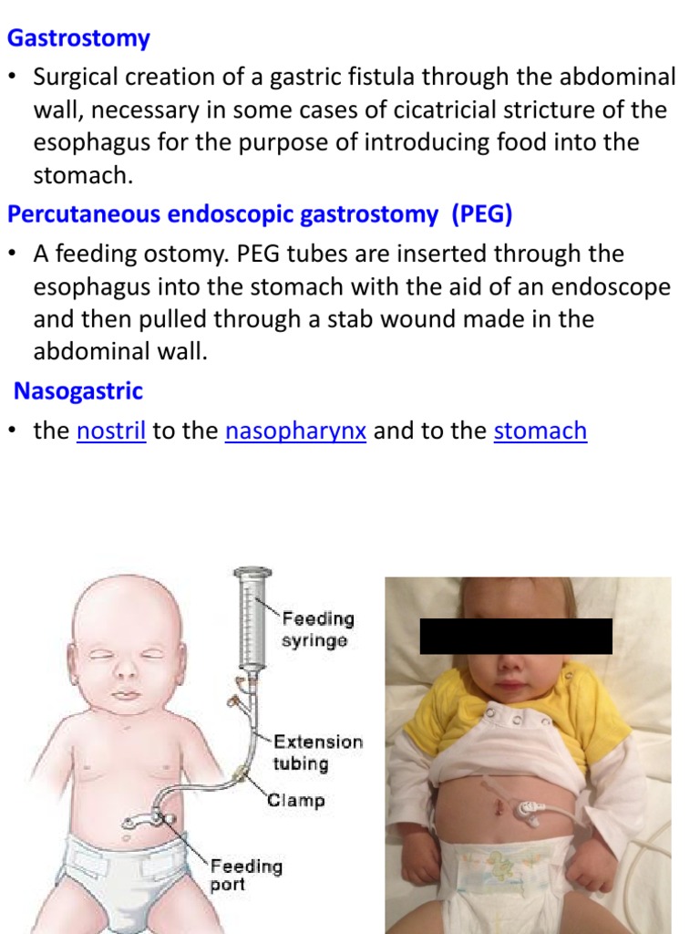 3 Gastrointestinal Intubations | PDF | Medical Procedures | Medical ...