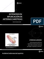 Estenosis en Bifurcacion de Carotidas