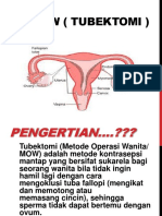 KB MOW (TUBEKTOMI) - Kontrasepsi Metode Operasi Wanita