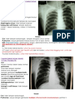 Pancoast Tumor: Kalo Gak Ada Destruksi Tul. Bronkogenic Duluan