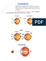 Astigmatism o