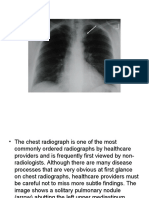Easy to Miss on Chest Radiographs