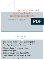 Multiple Congenital Granular Cell Epulis in a Female