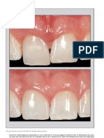 360939773-Flapless-Postextraction-Socket-Implant-Placement-in-the-Esthetic-Zone-Part-1-The-Effect-of-Bone-Grafting-and-or-Provisional-Restoration-on-Facial-Pa.pdf