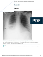 Derrame Pleural - Trastornos Pulmonares - Manual MSD Versión Para Profesionales 3