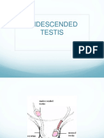 Undescended Testis