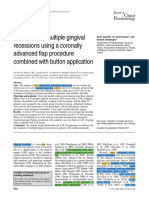 Treatment of Multiple Gingival Recessions Using A Coronally Advanced Flap Procedure Combined With Button Application